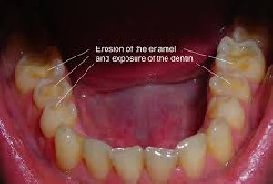 Treatment for Tooth  Picture