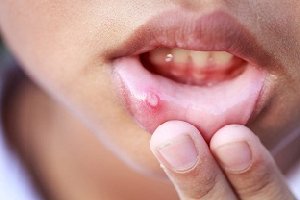 Common Mouth Sores offer Health & Beauty