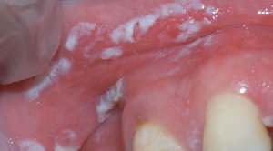 Treatment for Thrush offer Health & Beauty