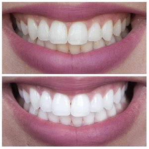 Teeth Whitening Trea offer Health & Beauty