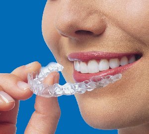 Invisalign Treatment offer Health & Beauty