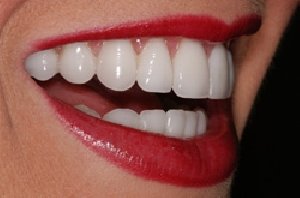 Porcelain Veneers and Its Uses offer Health & Beauty