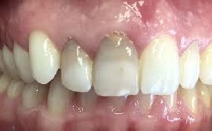 Internal Tooth Bleaching Treatment offer Health & Beauty