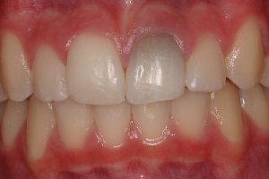 Internal Bleaching offer Health & Beauty