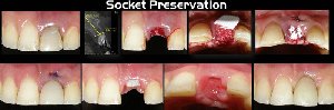 Socket Preservation offer Health & Beauty