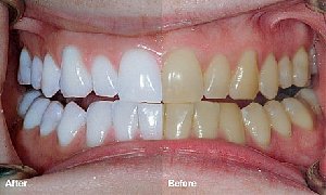 Zoom Teeth Whitening offer Health & Beauty