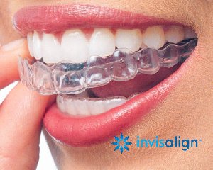 Invisible Braces for Teeth Straight offer Health & Beauty