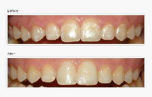 No Drill Dentistry offer Health & Beauty