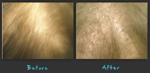 Book a Hair replacement consultant offer Health & Beauty