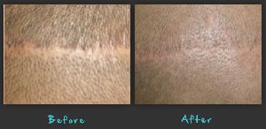 Book a Hair replacement consultant Picture