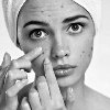 Peel for Acne in Cardiff Picture