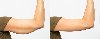 Arm Fat Reduction Surgery offer Health & Beauty