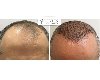 Hair transplant clinic in London | Fortes Clinic offer Health & Beauty