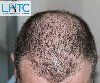 Hair Loss Transplant Clinic in L... Picture